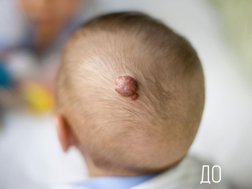 Лечение гемангиом с помощью лазера "До"