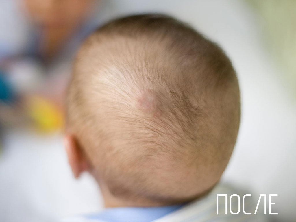 Лечение гемангиом с помощью лазера "После"